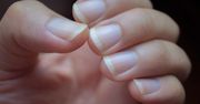 Wyglądają niegroźnie, a mogą wskazywać problem z wątrobą lub jelitami. Czym są paznokcie Lindsaya?