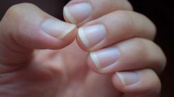 Wyglądają niegroźnie, a mogą wskazywać problem z wątrobą lub jelitami. Czym są paznokcie Lindsaya? 