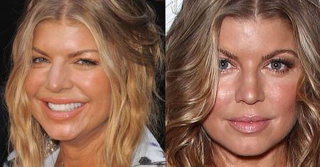 Fergie PO OPERACJI PLASTYCZNEJ?!