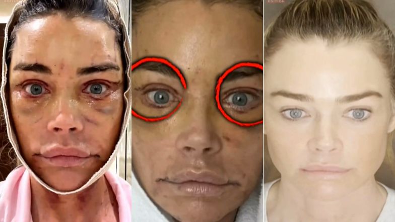 Denise Richards pokazała nagranie z liftingu twarzy