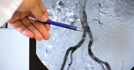 Zespół Leriche’a - przyczyny, objawy, diagnostyka, leczenie