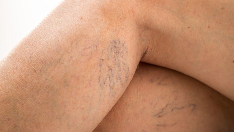 Maść arnikowa pomoże w walce z pajączkami na nogach