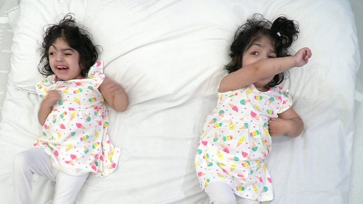  Safa i Marwa Ullah przeszły operacje rozdzielania głów.