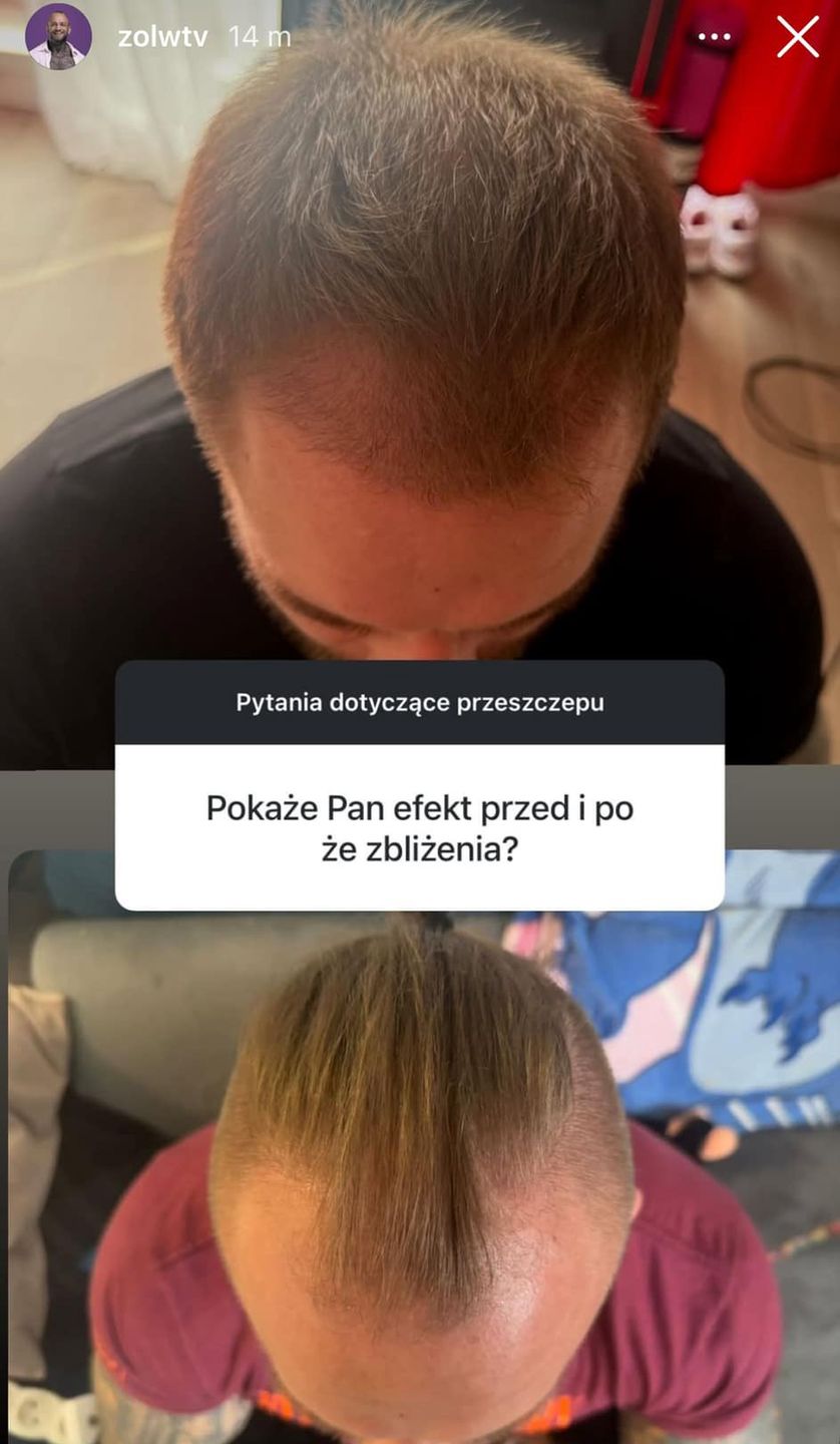 Chłopak Ewel0ny chwali się efektem przeszczepu włosów