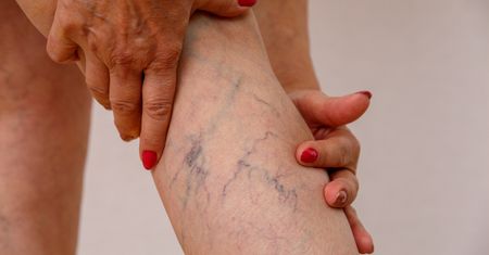 Ekspresowa droga do żylaków. Tak osłabiasz swoje żyły