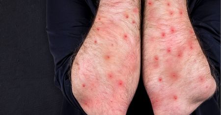 Trzy razy więcej Polaków zachoruje tylko w tym roku. Alarmujące dane