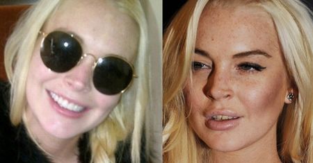 Lindsay wstawiła sobie nowe zęby! (FOTO)