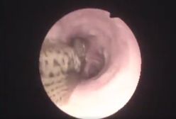 Żywa ryba utknęła w oskrzelach 12-latka. Szokujące nagranie