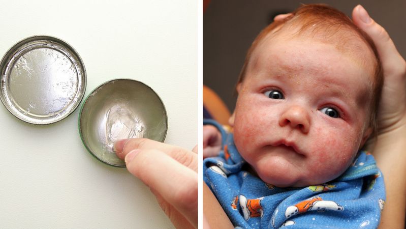 Wazelina ratunkiem w atopowym zapaleniu skóry u dzieci