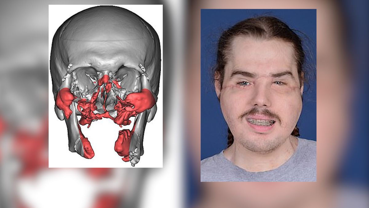 Mężczyzna odstrzelił sobie twarz. Przeszczepiono mu nową 