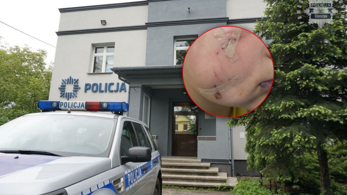 Franio został pogryziony przez psa.