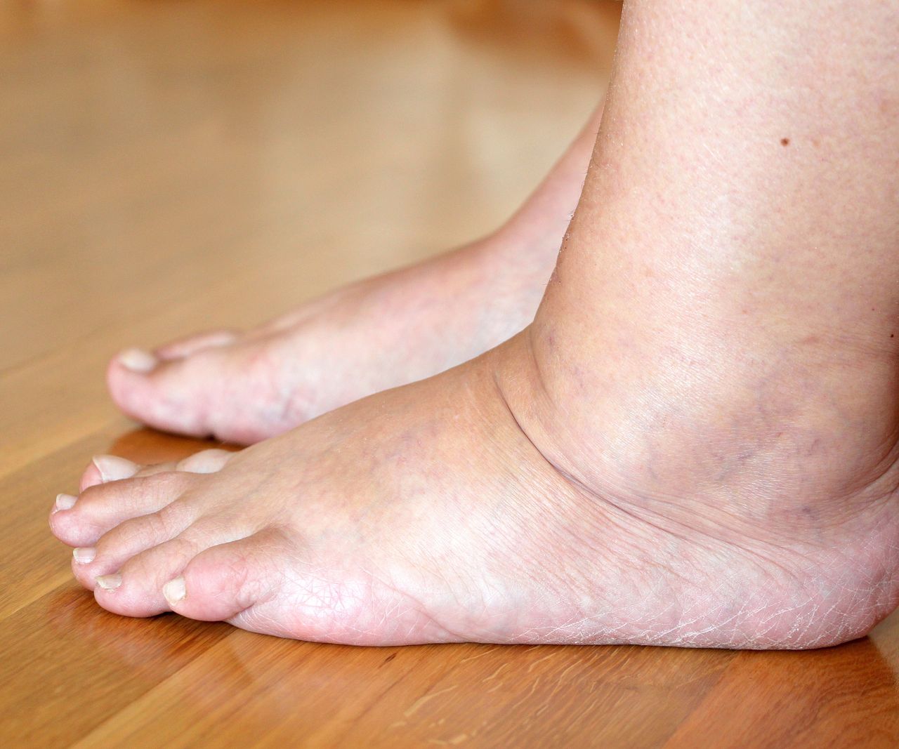 Summer foot care: How vinegar can alleviate swelling and pain