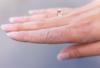 Suche dłonie zimą? Domowa maska zadziała lepiej niż drogi krem