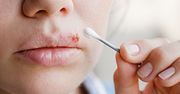 Domowe sposoby na opryszczkę. Przyczyny i objawy opryszczki