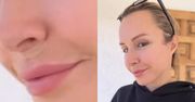 Blanka Lipińska relacjonuje lifting ust po usunięciu kwasu: "Jakość skóry pod nosem teraz jest dużo lepsza"