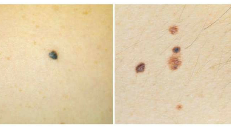 Wielkość i ilość znamion i pieprzyków