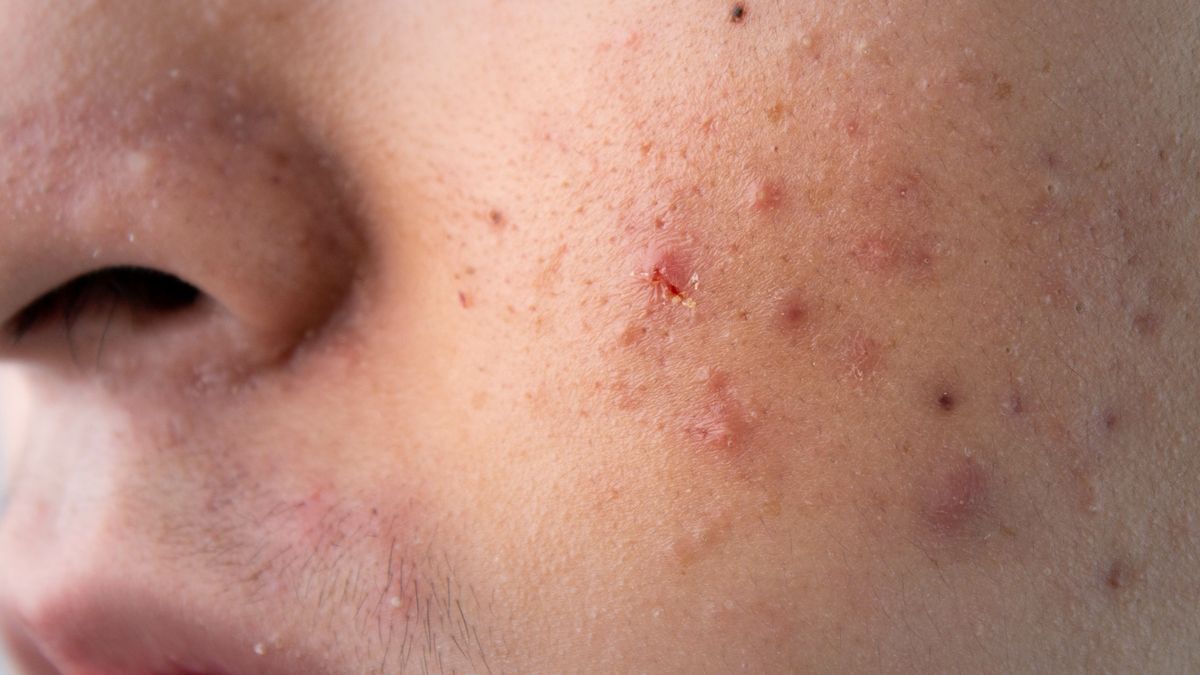 Trądzik pospolity to problem wielu pacjentów.