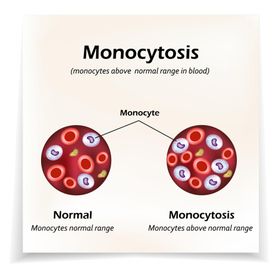 Monocytoza – przyczyny, diagnostyka i leczenie