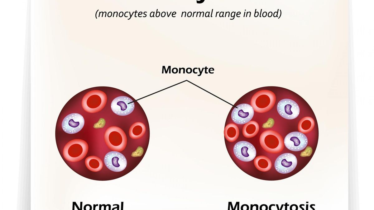 Monocytoza to zwiększenie poziomu monocytów we krwi obwodowej ponad normę.