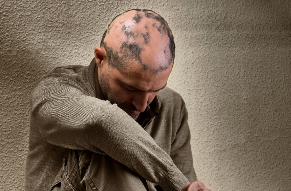 A man suffering from alopecia areata