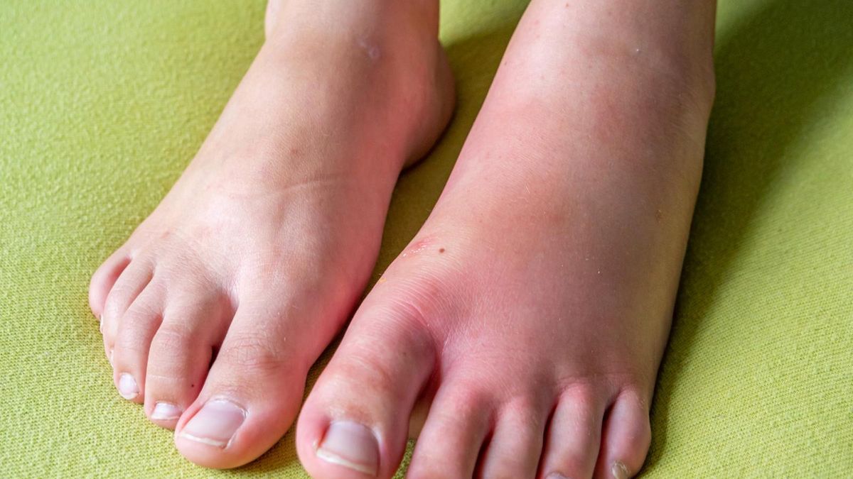 Wysypka alergiczna może mieć wiele różnych przyczyn.