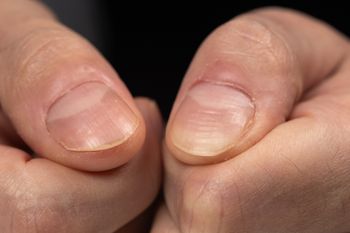 Widzisz na paznokciach? Pod żadnym pozorem nie lekceważ