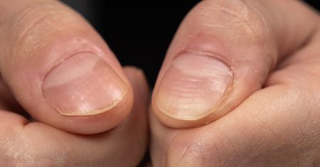 Widzisz na paznokciach? Pod żadnym pozorem nie lekceważ