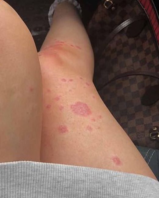 Swędzące plamy pokrywały całe jej ciało.