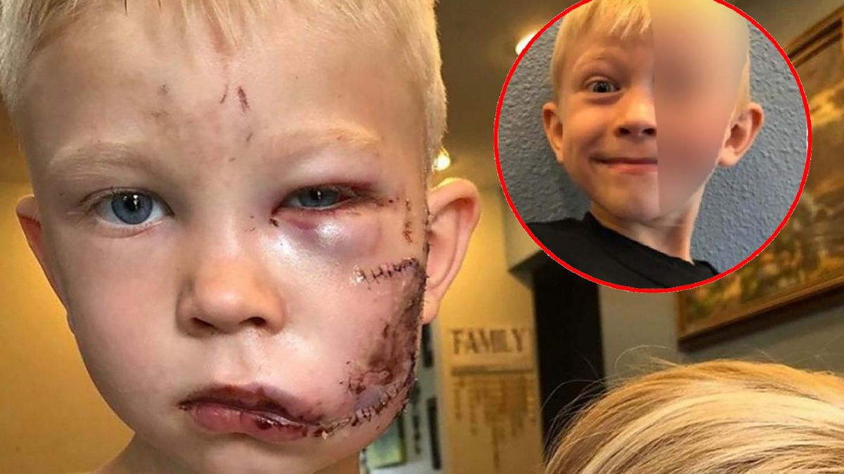Po okropnym wypadku na twarzy chłopca została blizna