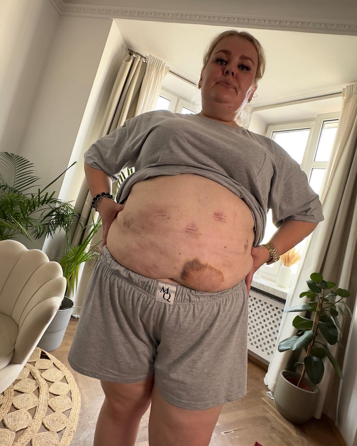 Kinga Zawodnik mówi o plastyce brzucha