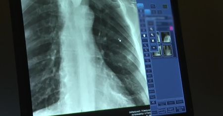 Płuca, zapomniany narząd? Tegoroczny finał WOŚP przypomina o tych, dla których każdy oddech jest walką