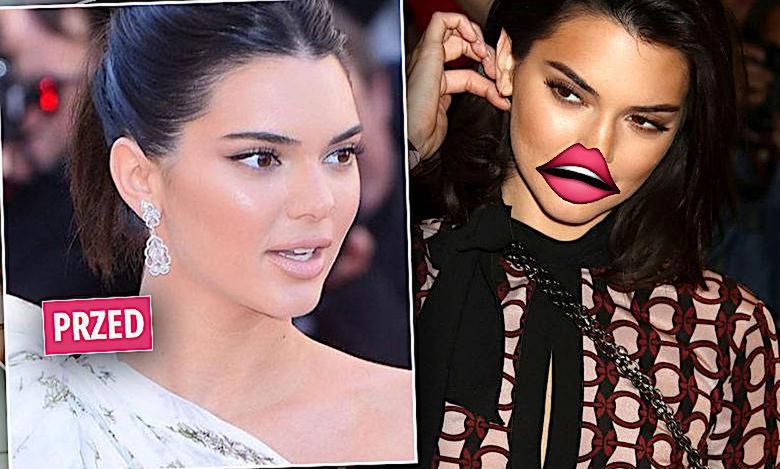 Kendall Jenner ma większe usta