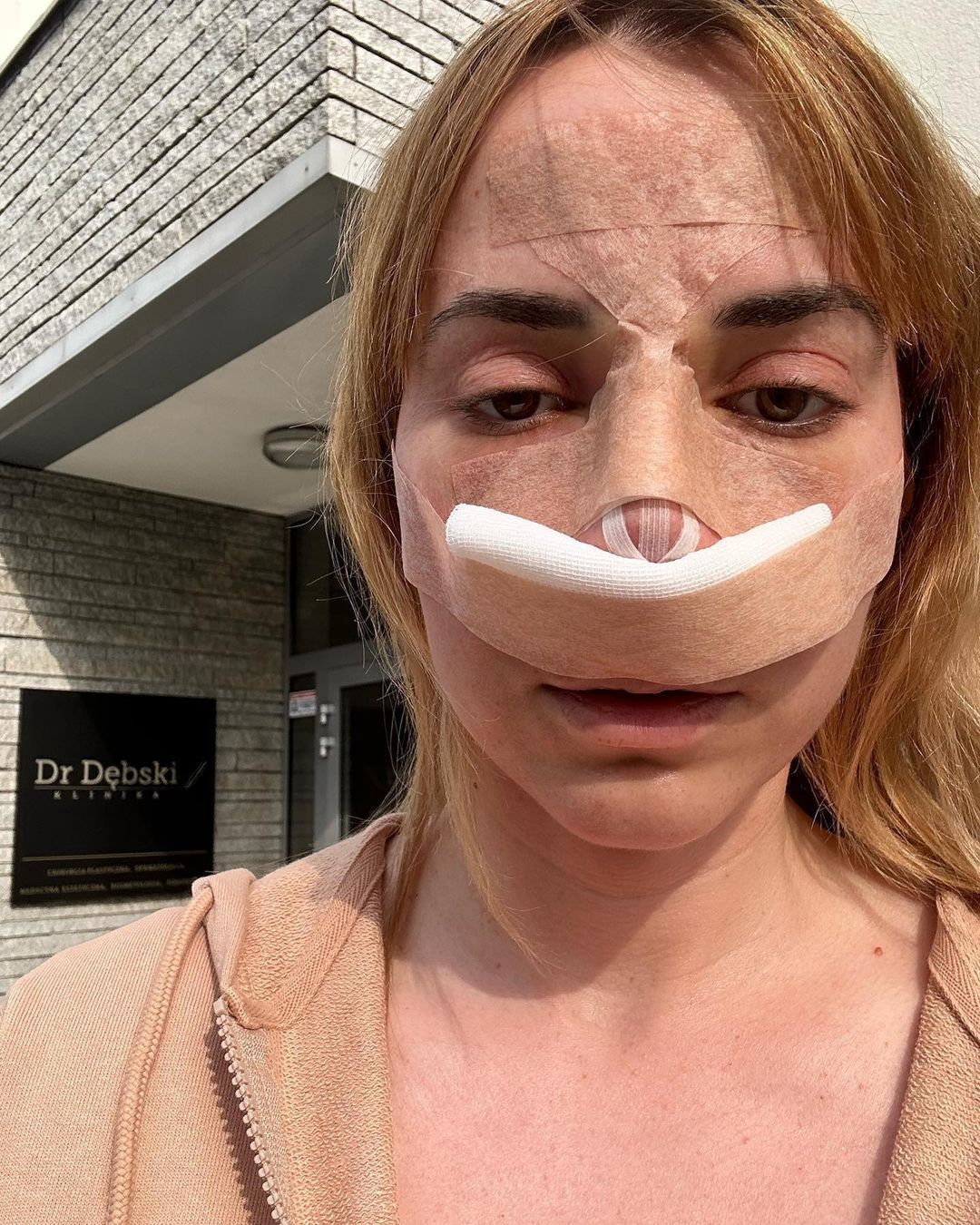 Marianna Schreiber po operacji nosa