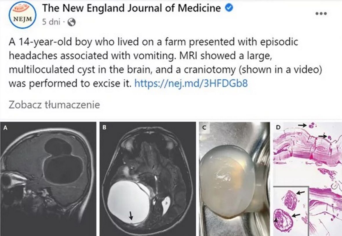 Przypadek chłopca opisano w periodyku naukowym &quot;The New England Journal of Medicine&quot;