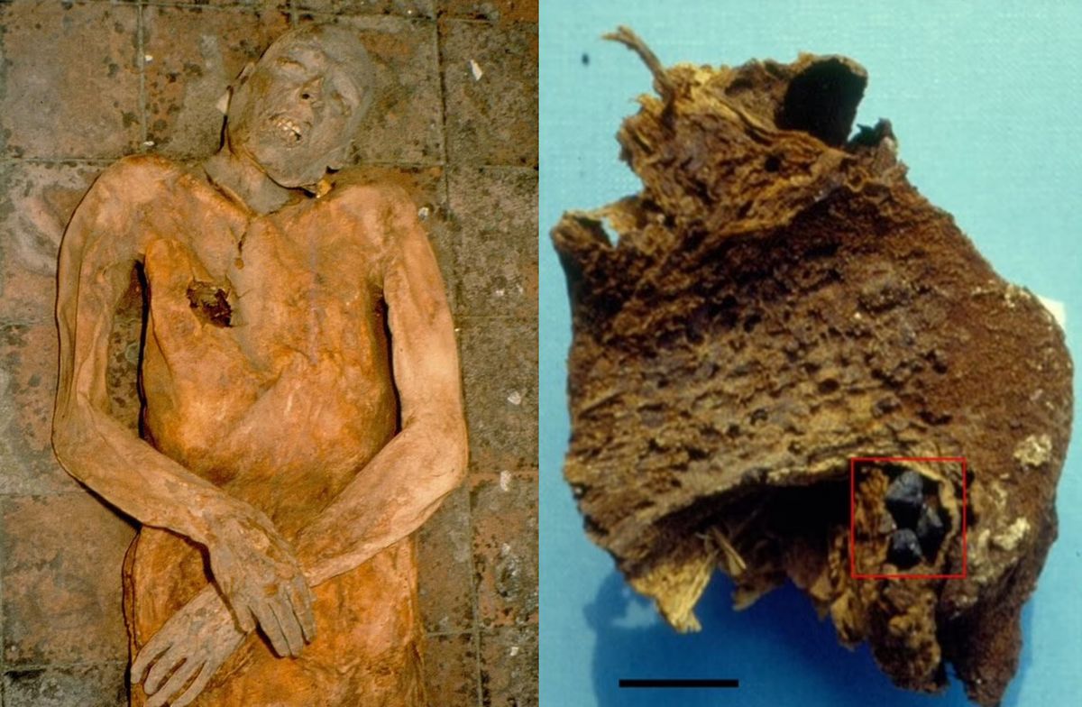 Mumia Giovaniego d'Avalos i jego pęcherzyk żółciowy, z któego pobrano materiał 