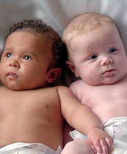 Bliźniaki zmieniają kolor skóry