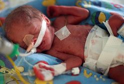 W Krakowie na świat przyszły pięcioraczki