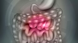 Rak jelita grubego coraz częstszy u Polaków. Rozmowa z dr. Krzysztofem Abychtem