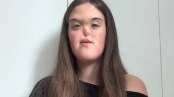 18-letnia Paulina urodziła się bez nosa: "Ludzie pokazywali na mnie PALCAMI"