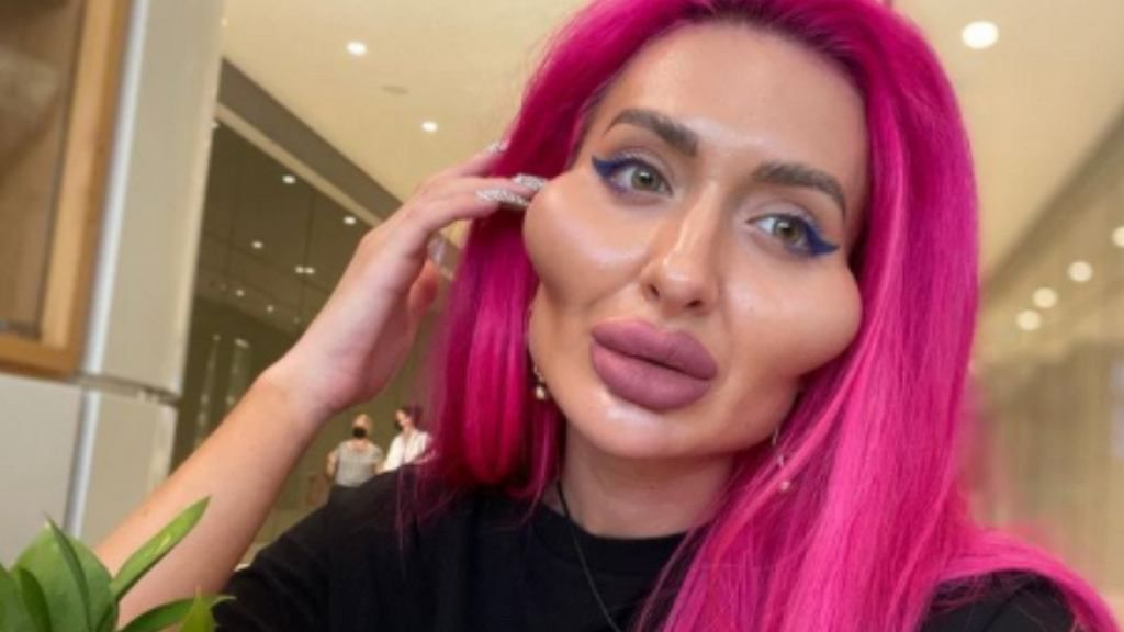 Nie skończyło się na jednym zabiegu. Modelka jest uzależniona od operacji plastycznych