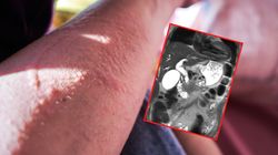 Jedynym objawem było swędzenie. Tak maskował się jeden z najgroźniejszych nowotworów