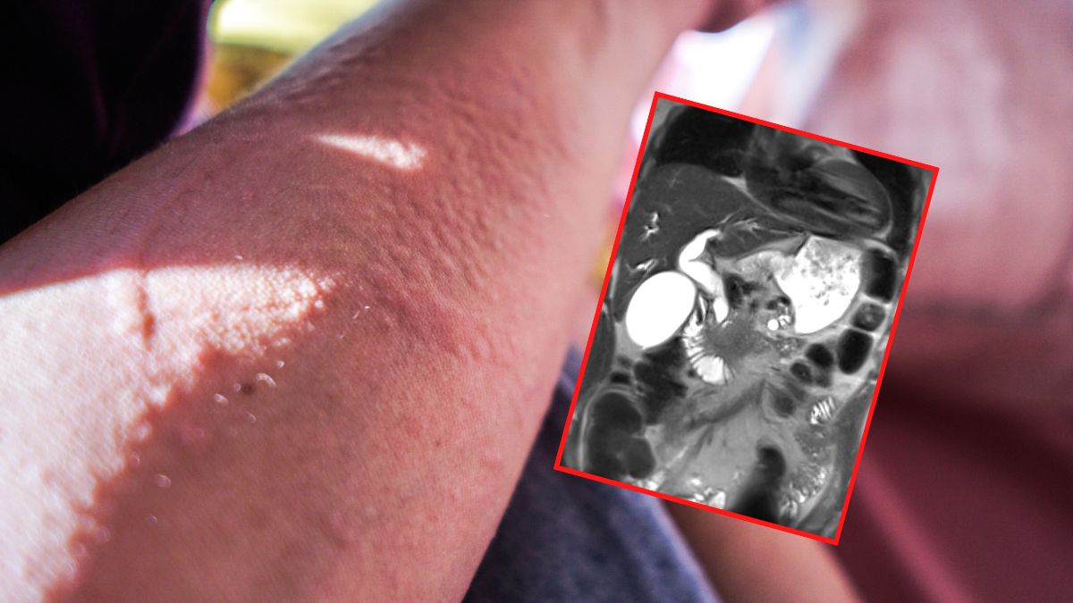 Rak trzustki należy do najbardziej podstępnych nowotworów