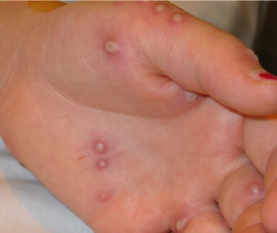 Charakterystyczną dolegliwością w przebiegu małpiej ospy jest wysypka na ciele