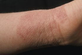 Alergia kontaktowa – przyczyny, objawy, leczenie i profilaktyka