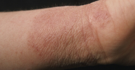 Alergia kontaktowa – przyczyny, objawy, leczenie i profilaktyka