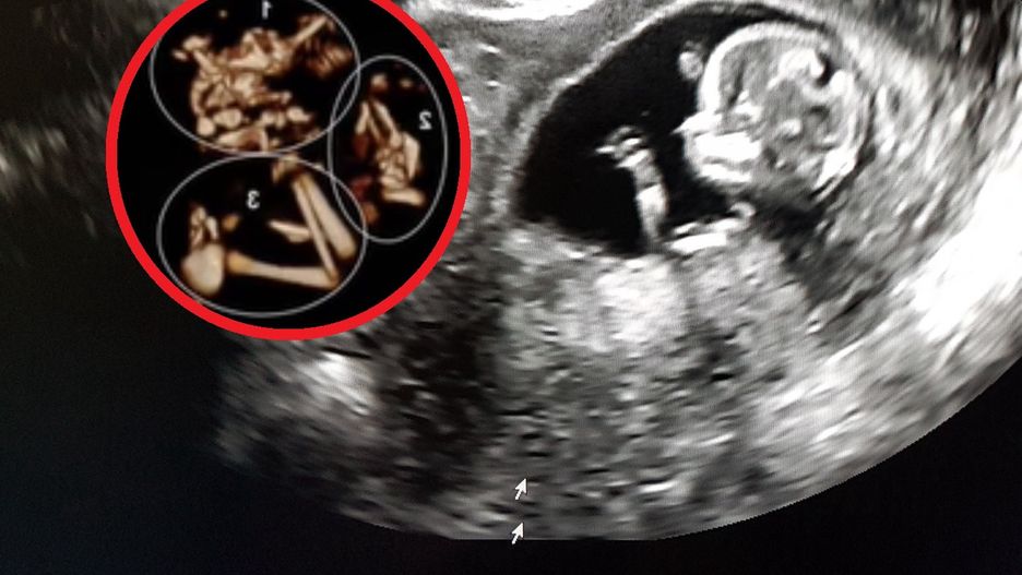 Niepokojący szczegół zwrócił uwagę podczas USG. Rodzice musieli podjąć trudną decyzję