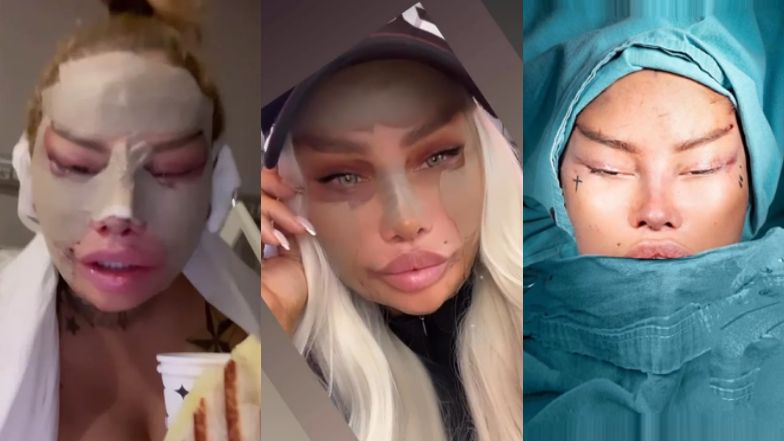 Laluna Unique chwali się efektami zabiegów w tureckiej klinice