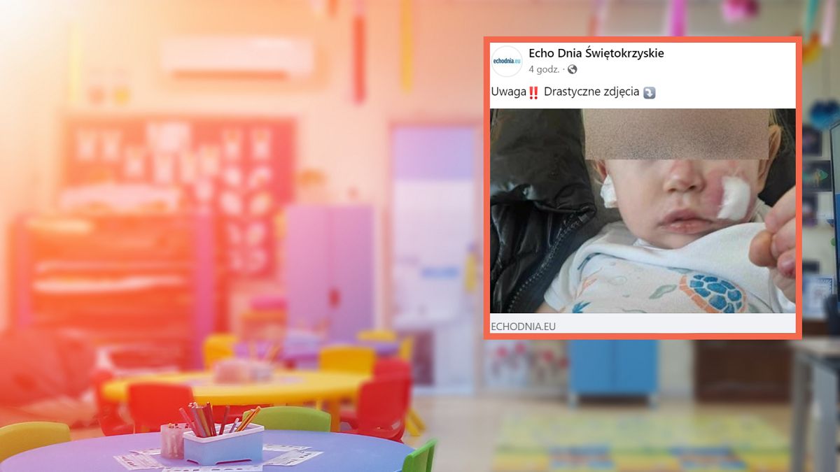 Szok w żłobku. Dwulatka pogryzła chłopczyka. 