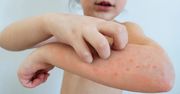 Wysypka u dziecka - alergia czy choroba zakaźna?