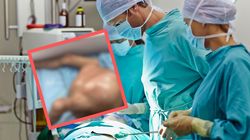 Wyjątkowa operacja chirurgów z Indii. Usunęli guza o wadze dziecka 